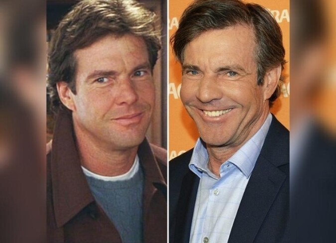 Dennis Quaid's Plastic Surgery: The Blue Miracle Star Underwent Plastic ...