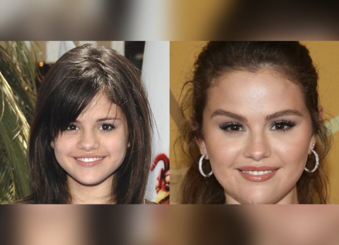 Selena Gomez Plastic Surgery: Has The Singer Undergone A Plastic Surgery?